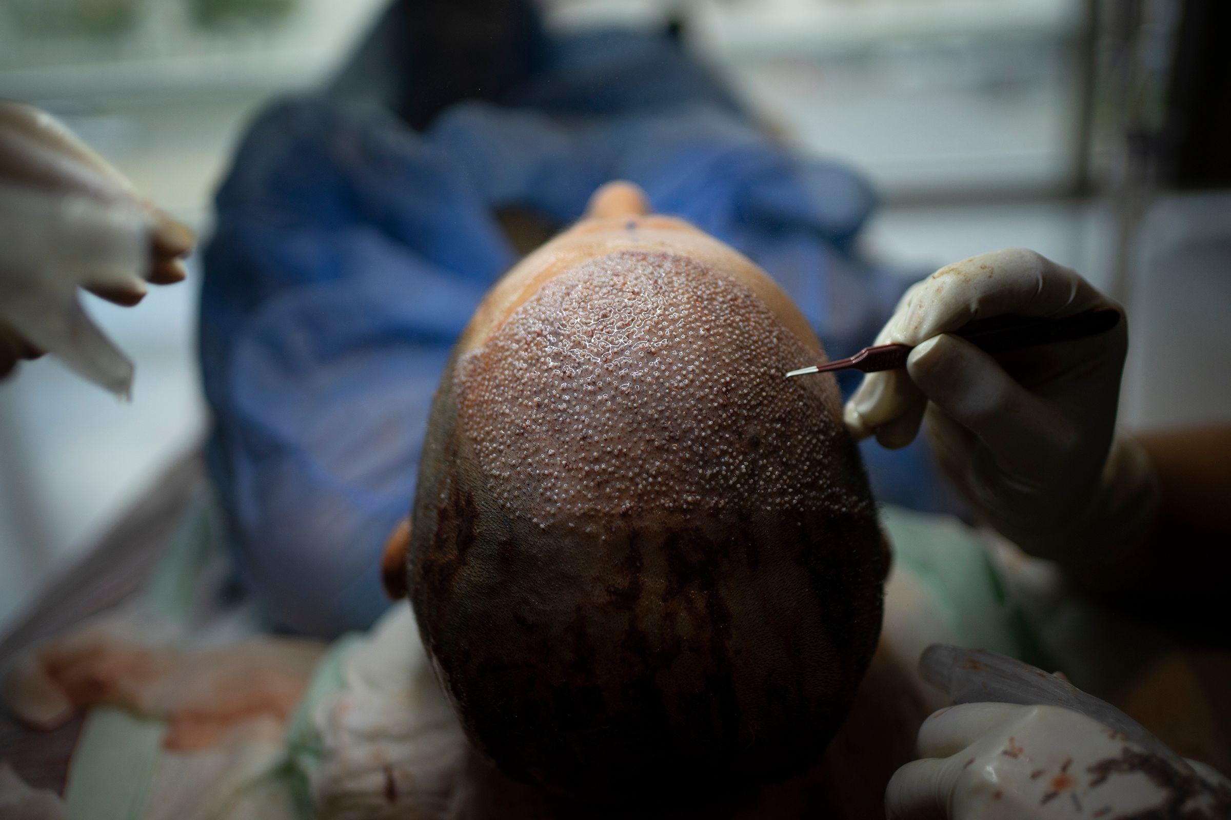 Turkey's Hair Transplant Boom: Fueled by Innovation and Tech